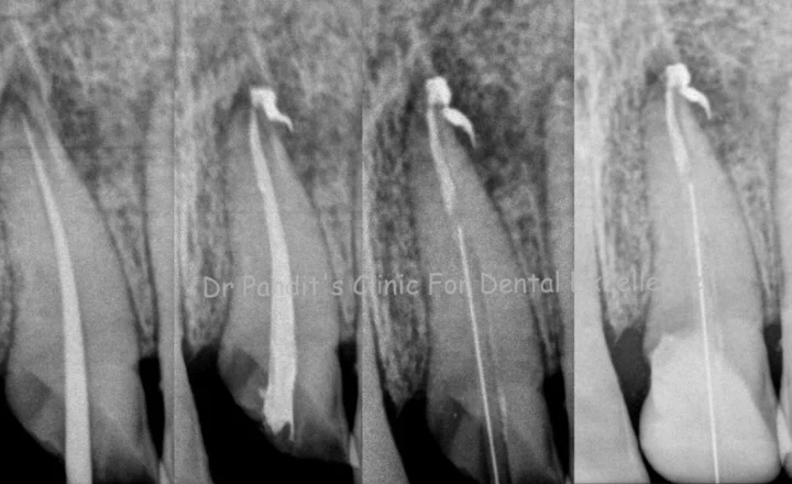 Root Canal Treatment in Pune